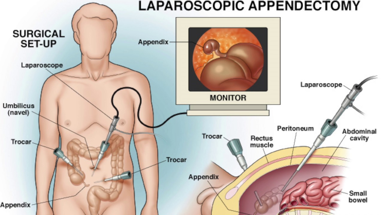 Best Laparoscopic Surgeon in Bangalore